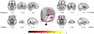 Cerebral perfusion alterations in patients with trigeminal neuralgia as measured by pseudo-continuous arterial spin labeling